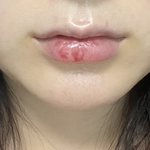 [19] 경락 전후 보여줌 노<b>필터</b> 노보정