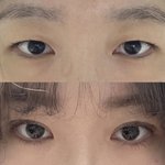 나 쌍수<b>전후</b>차이볼사람
