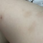[댓글부탁해] 다리 이거 ㄹㅇ 스트레스 받는데 <b>어떡</b>해..?