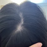 이거 탈모같음..?