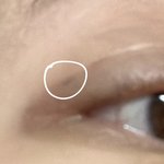 <b>매몰</b>로 쌍수한애들아.. 이게맞는거임?