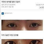 남자 눈 성형 <b>내기준</b> 이게 젤 잘됨