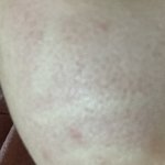 [댓글부탁해] 약혐일수도))얘들아 나 피부 왜 이런거임.?