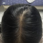 [댓글부탁해] 나 <b>탈모</b> 같음????
