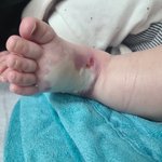 [꼭조언부탁] 신생아 엄마의 눈물:대학병원갑질/수액 맞고아기 피부괴사ㅠㅠ...