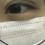 쌍수 3일차인데 붓기 <b>어</b>떰
