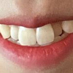 [댓글부탁해] <b>덧니</b> 평가좀