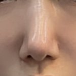 너네 코수술했는데 이렇게 되면 어떨거같음