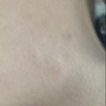 피부 트러블 잘 아는 애들 있음?
