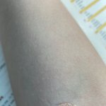 병원가서 피뽑앗는데 <b>피멍</b>듬…..