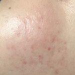 [댓글부탁해] (혐주의) 여드름 <b>흉터</b> 어케해야돼?