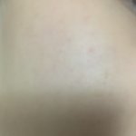 볼 트러블애매 빨갛게 <b>홍조</b>?생긴거 못되돌림?