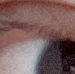 쌍수 <b>점막</b> 들리는 거 정상이야..?