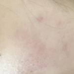 나 여드름 <b>흉터</b> 어떡하지