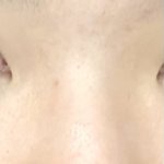 [댓글부탁해] 나 코 수술하면 되는 <b>코야</b>??