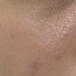 개학 4일 남기고 피부 뒤집어진 사람이 있다?