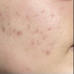 나 피부 오돌토돌한거 다 <b>없어</b>졌는데