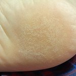 [드루와] 내 발바닥 왜이래 나 <b>무좀</b>임?