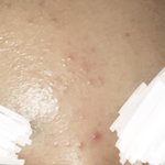 와 거의 한달만에 <b>좁쌀</b> 거의 다 없앰