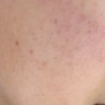 [드루와] 피부 붉은끼랑 <b>색소</b>침착 어떻게 없앰?ㅠㅠ