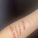 나 이 <b>흉터</b> 지울 수 있을까?