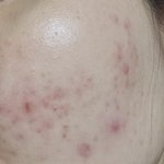 [꼭조언부탁] <b>화농성</b> 여드름 때문에 지칩니다. 좀 도와주세요