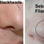 너네 남의 얼굴 볼 <b>때</b> <b>코</b>에 블랙헤드까지 봄?