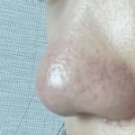 [댓글부탁해] 이런 코 어떡해야함ㅠㅠ