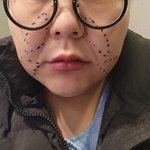 [하소연성형] 의료사고.후유증...삶이 싫어지는순간(긴글입니다....