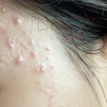나 여드름 <b>완전</b> 좋아졌지(사진있음)