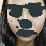 곧 엠티가는데 피부 <b>때매</b> 미치겠군