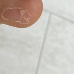 발가락사진임 이거 설마 <b>무좀</b>임?