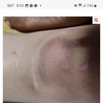 시병원 의료사고!!