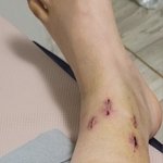 [<b>방</b>탈죄송] 교통사고 당하고 난 후 철심 제거 <b>수술</b> 받았네요..