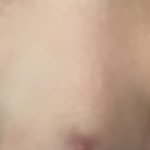 코 정중앙에 난 <b>왕뾰루지</b> 대체 어케 없앰?