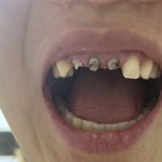 임플란트하게 생겼어요 치과는 과실없다하는데..치위<b>생사</b>분들 도와주세요