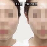 내기준 <b>안면</b>윤곽 레전드