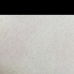 튼살 보기 많이 <b>흉측</b>함?????ㅠㅠㅠ