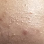 [댓글부탁해] 혐주의) 3월부터 내여드름<b>변화</b> 좀 봐줘…