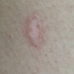 [이것좀봐줘] <b>화상</b>입은것같은데어캄요