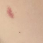 [어떻게생각] 키스<b>마크</b>인가요?