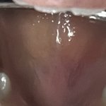 <b>입천장</b> 구내염 아니죠?