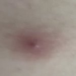 나 ㄹㅇ 여드름이 ㅈㄲㅈ처럼 났어 <b>어떡</b>해..?