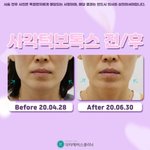 사각턱보톡스 전후 사진인데 나만 <b>전이</b> 낫냐