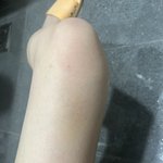 [댓글부탁해] (다리<b>사진</b><b>주</b>의) 다리에 멍은 어떻게 해결함?