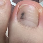 [이것좀봐줘] <b>발톱</b>에 검은점 났는데