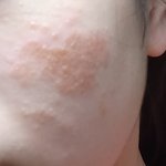 [댓글부탁해] 피부 줫창났는데 이거 뭔거 같음?