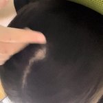 나진심 원형<b>탈모</b>인기봐