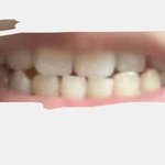 [드루와] 나처럼 부정<b>교합</b>인데 하관은 멀쩡한 편이면