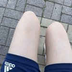 [19] 나 다리에 멍 어떡하냐...???